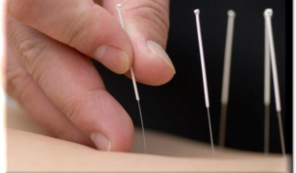 acupunctura