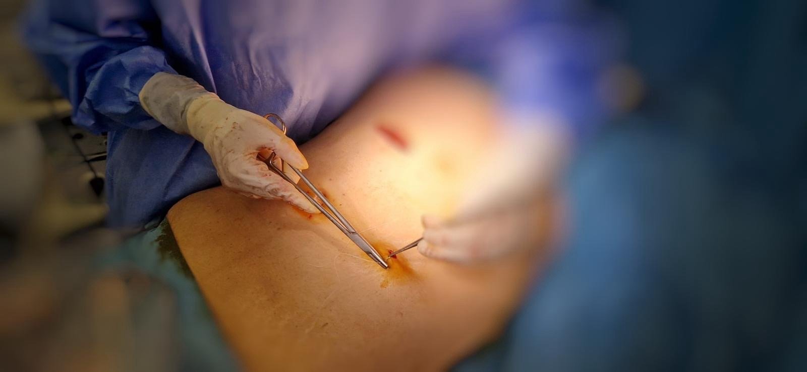 Operație laparoscopică de înaltă tehnologie la SCJU Sibiu. Recuperare rapidă pentru un pacient de 80 de ani